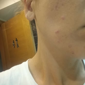 Maruderm Ürünleri Yüzümü Mahvetti