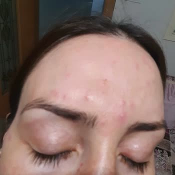 Bee Beauty Cilt Kremi Cildimi Mahvetti