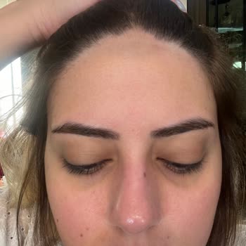 Mayasante (Ankara) Yanlış Bölgeye Lazer Uygulaması