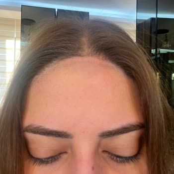 Mayasante (Ankara) Yanlış Bölgeye Lazer Uygulaması