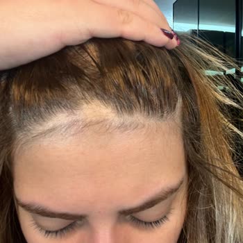 Mayasante (Ankara) Yanlış Bölgeye Lazer Uygulaması