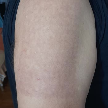 Kurtsan Medikal Yakı Yan Etki