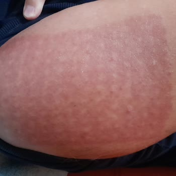 Kurtsan Medikal Yakı Yan Etki