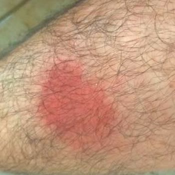 Kepez Belediyesi Sivrisinek Ve Böcekler Hk.