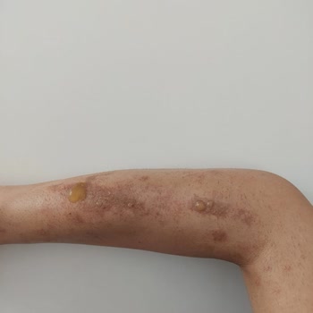 Parkhayat Akşehir Hastanesi Lazer Epilasyon Yanığı