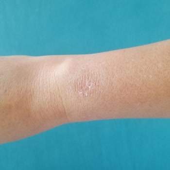 Huawei Watch Gt3 Pro Saatin Kolda Yanma Ve Döküntü Yapması