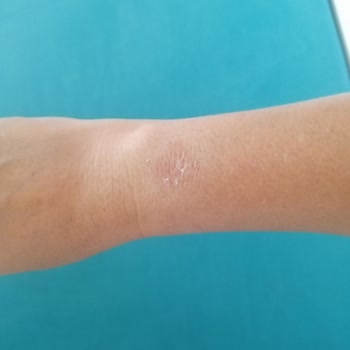 Huawei Watch Gt3 Pro Saatin Kolda Yanma Ve Döküntü Yapması