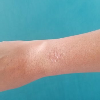 Huawei Watch Gt3 Pro Saatin Kolda Yanma Ve Döküntü Yapması