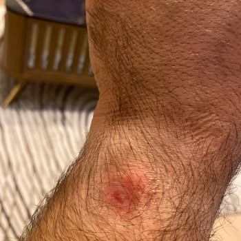 Huawei Watch GT2 Deride Yanık Yapıyor