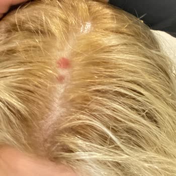 Palette Saç Derim Yanık!