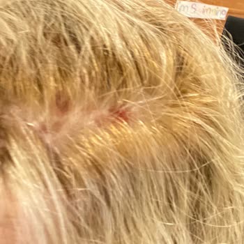 Palette Saç Derim Yanık!