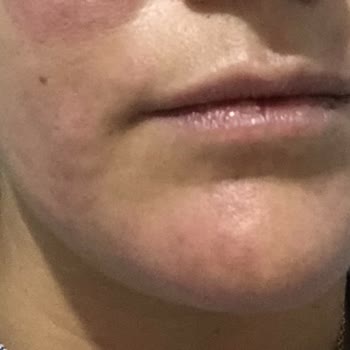 Institut Esthederm Esthederm Marka Ürünler Yüzümde Sivilce Yaptı Ve Döküntüye Sebep Oldu