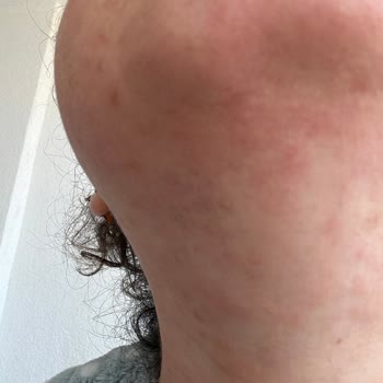 Benri Krem Tahriş Ediyor