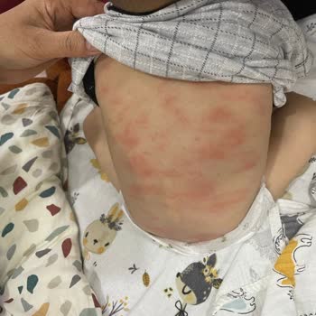 Bebeğime Mustela Alerji Yaptı