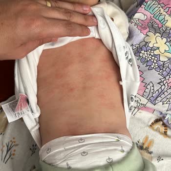 Bebeğime Mustela Alerji Yaptı