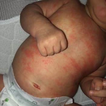 Bebeğime Mustela Alerji Yaptı