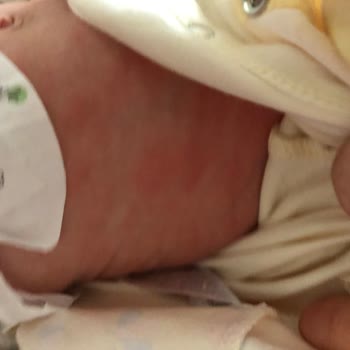 Bebeğime Mustela Alerji Yaptı