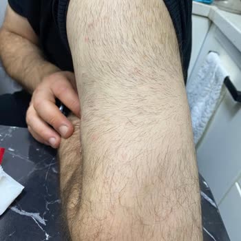 Özel Levent Dnz Polikliniği Epilasyon Mağduru!