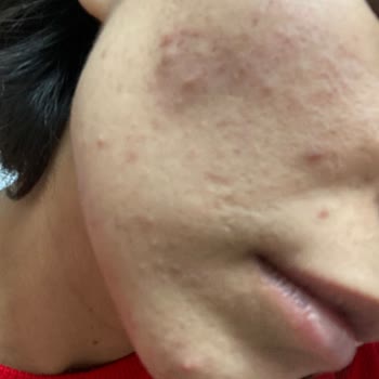 The Purest Solutions The Purest Ürünleri Yüzümü Mahvetti!