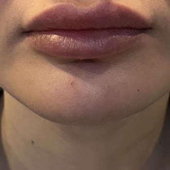 Bade Medikal & Cerrahi Estetik Danışmanlığı Çene Ve Dudak Dolgusu