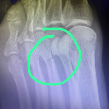 İzelman Otopark Peyzajı Nedeni Kırılan Ayağım