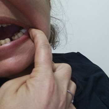 STR Dent İmplant Üstü Dışım Sallanıyor Büyük