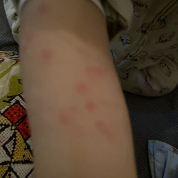 Enterogermina Bebeğime Alerji Yaptı