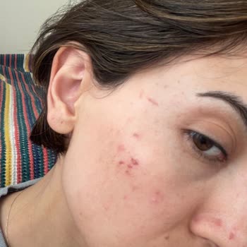 Estee Güzellik Ve Estetik Merkezi Estee Estetik Beauty İzmir Yüzüm Mahvoldu Yara İçinde