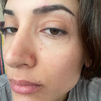 Estee Güzellik Ve Estetik Merkezi Estee Estetik Beauty İzmir Yüzüm Mahvoldu Yara İçinde