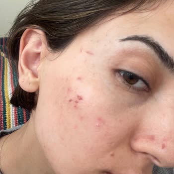 Estee Güzellik Ve Estetik Merkezi Estee Estetik Beauty İzmir Yüzüm Mahvoldu Yara İçinde