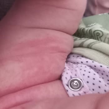 Mustela Bebeğimde Alerji Yaptı