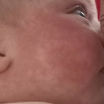 Mustela Bebeğimde Alerji Yaptı