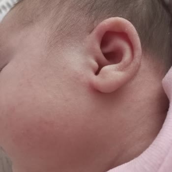 Mustela Bebeğimde Alerji Yaptı