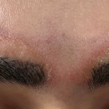 Estenora Beauty Center Microblading Silme İşlemi