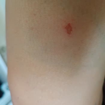 Yumoş Lilyum Mavi Alerji