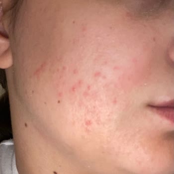 Cream Co Yüzümü Kızarttı Ve Tüylenme Yaptı