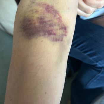 Çankaya Yaşam Hastanesi Çalışanları Damar Yolu Bile Açamıyor