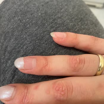 Kalıcı Oje Soyulması