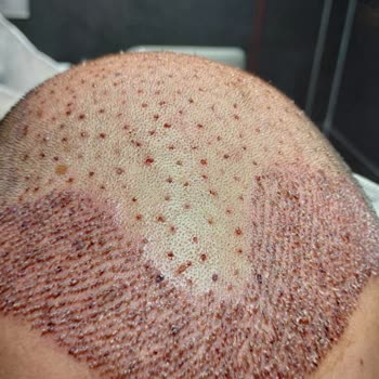 Sapphire Hair Clinic Saçlarımı Perişan Etti