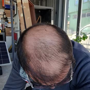 Sapphire Hair Clinic Saçlarımı Perişan Etti