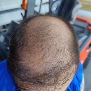 Sapphire Hair Clinic Saçlarımı Perişan Etti