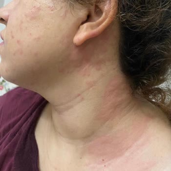 Dr. Öz Klinik Krem Ve Peeling Aldım Vücudumu Çok Kötü Yaptı