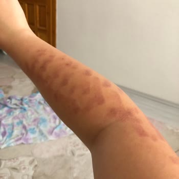 Anatolia Güzellik Merkezi Bronz Tene Lazer Yapılması 1. 2. Derece Kolumda Yanıklar Oluşması