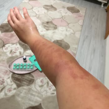 Anatolia Güzellik Merkezi Bronz Tene Lazer Yapılması 1. 2. Derece Kolumda Yanıklar Oluşması