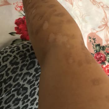 Anatolia Güzellik Merkezi Bronz Tene Lazer Yapılması 1. 2. Derece Kolumda Yanıklar Oluşması