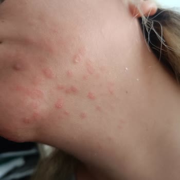 Sağlık Bakanlığı Çaresi Olmayan Hastalık Uyuza Çare Bulun