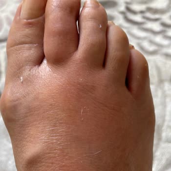 Selin Beauty Center Güzellik Merkezi Pediküre Bağlı Enfeksiyon