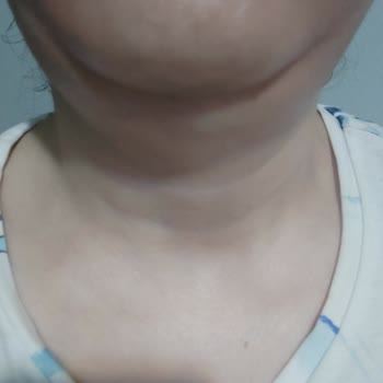 Estpoint Yapılamayan Gıdı Liposuction...