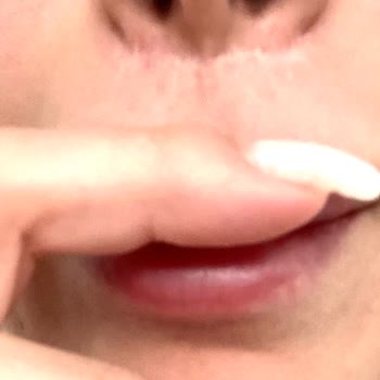 Sym Estetik Dudak Kaldırma Operasyonu