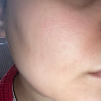 Licape Thermal Su Yüzümü Yaktı